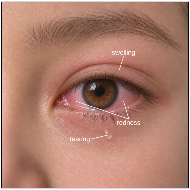 Illustration of allergic conjunctivitis in a child’s eye, showing redness, swelling and tearing
