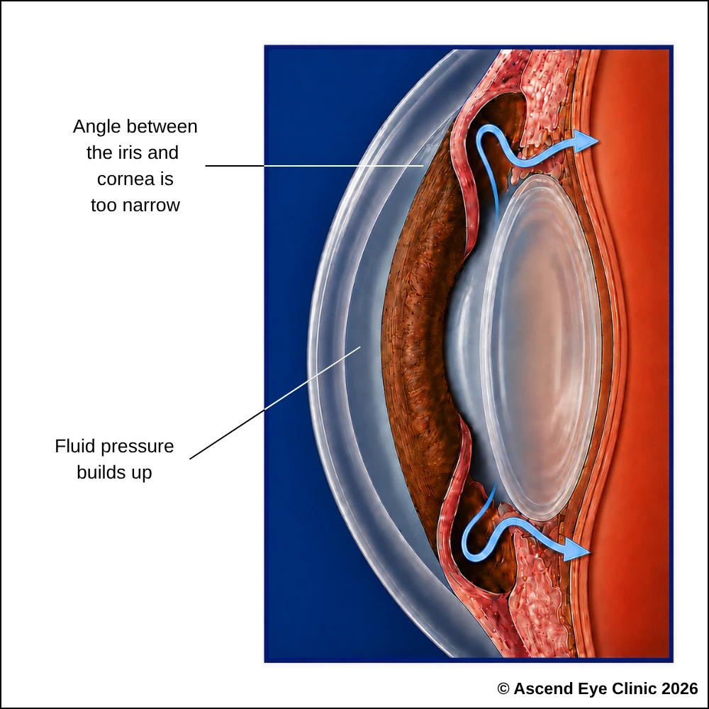 Angle closure glaucoma diagram showing a narrow angle between the iris and cornea and fluid pressure building up