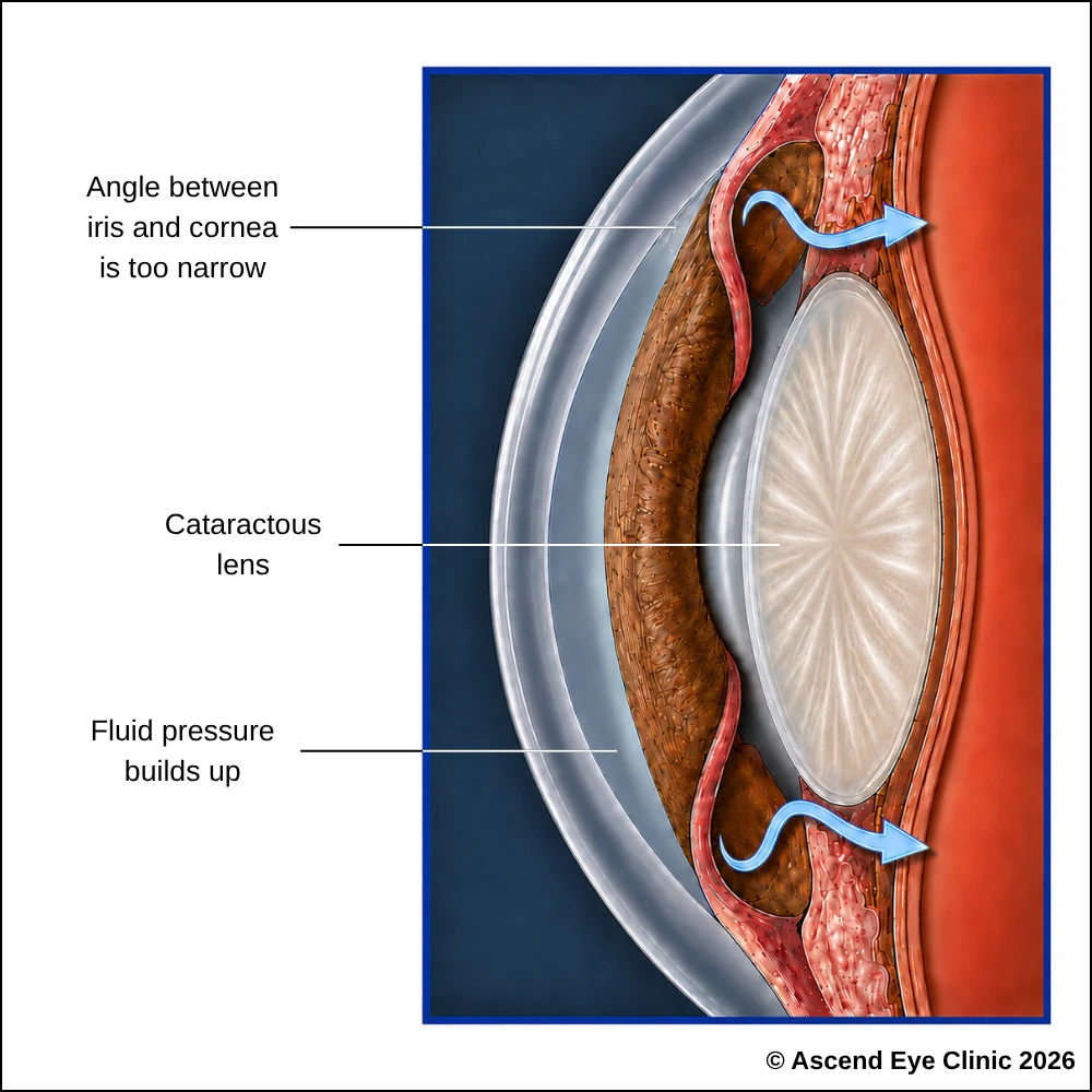 Diagram of angle closure with a cataract, showing a narrow angle between the iris and cornea, a cataractous lens and fluid pressure building up