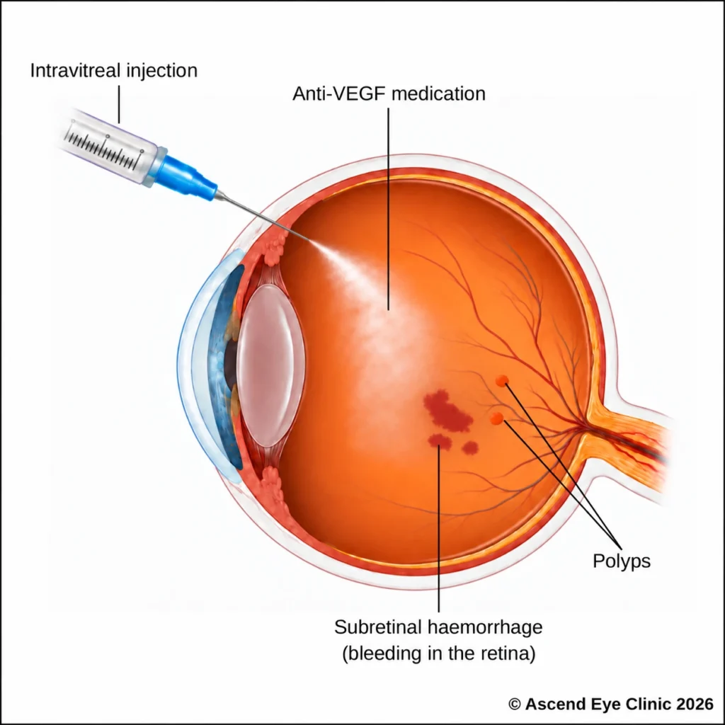 Diagram of an anti-VEGF intravitreal injection for polypoidal choroidal vasculopathy