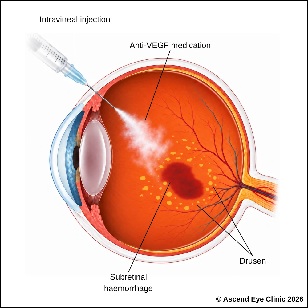 Diagram of an anti-VEGF intravitreal injection for wet age-related macular degeneration