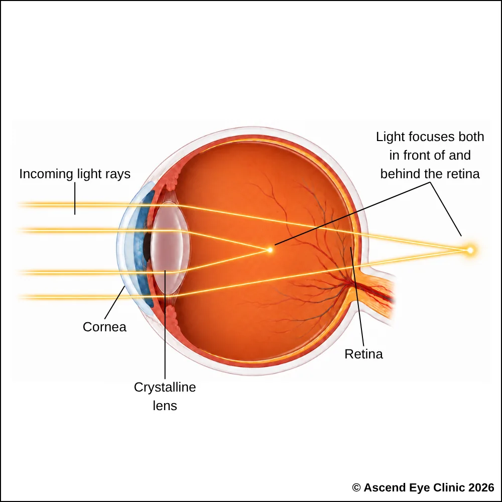 Diagram of astigmatism showing light focusing at more than one point