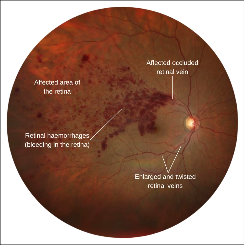 Diagram of a branch retinal vein occlusion affecting part of the retina