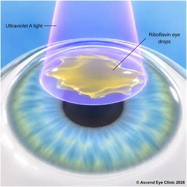 Illustration of corneal collagen cross-linking with riboflavin eye drops and ultraviolet A light