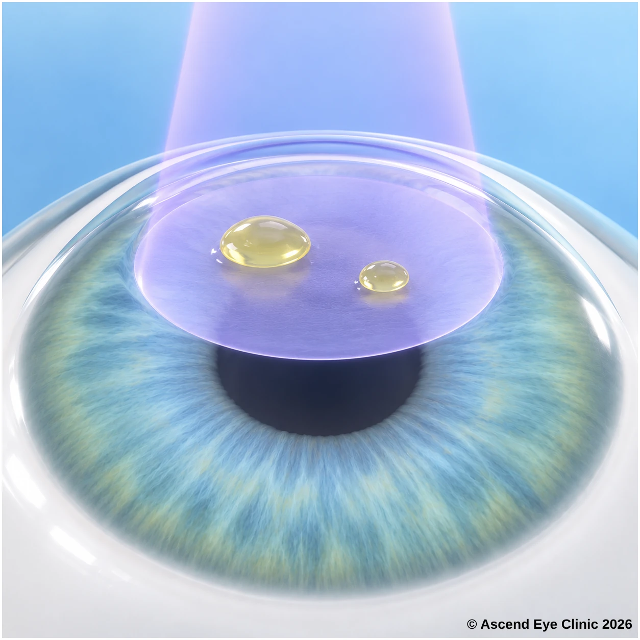 Illustration of corneal collagen cross-linking showing riboflavin drops and ultraviolet light applied to the cornea