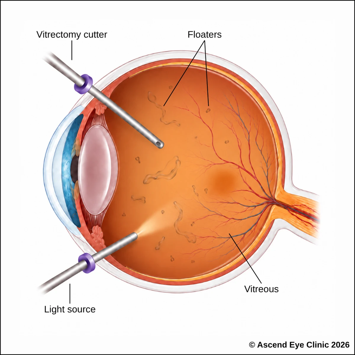 Floater vitrectomy removing vitreous opacities