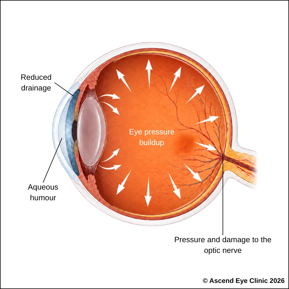 Diagram of glaucoma showing reduced drainage, eye pressure buildup and damage to the optic nerve