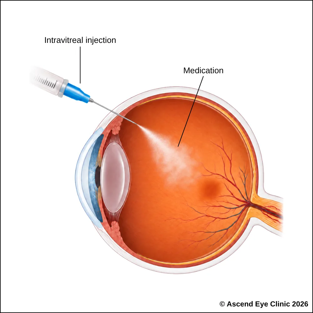 Illustration of an intravitreal injection into the eye