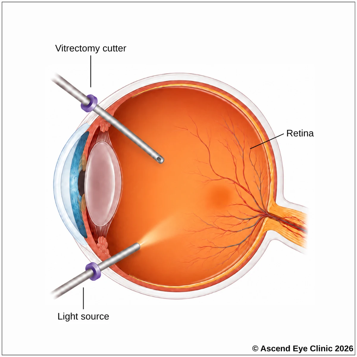Vitrectomy surgery with vitrectomy cutter and light source inside the eye
