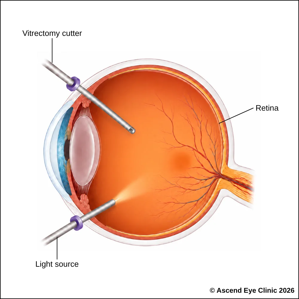 Illustration of a vitrectomy procedure removing the vitreous gel