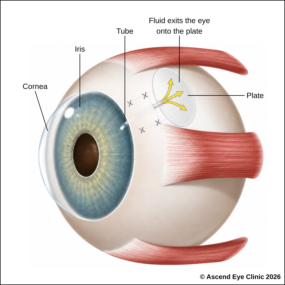 Glaucoma drainage implant diagram showing the tube and plate allowing fluid to exit the eye