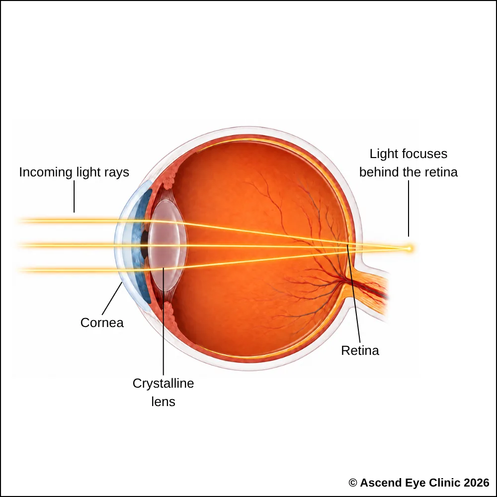 Diagram of hyperopia showing light focusing behind the retina