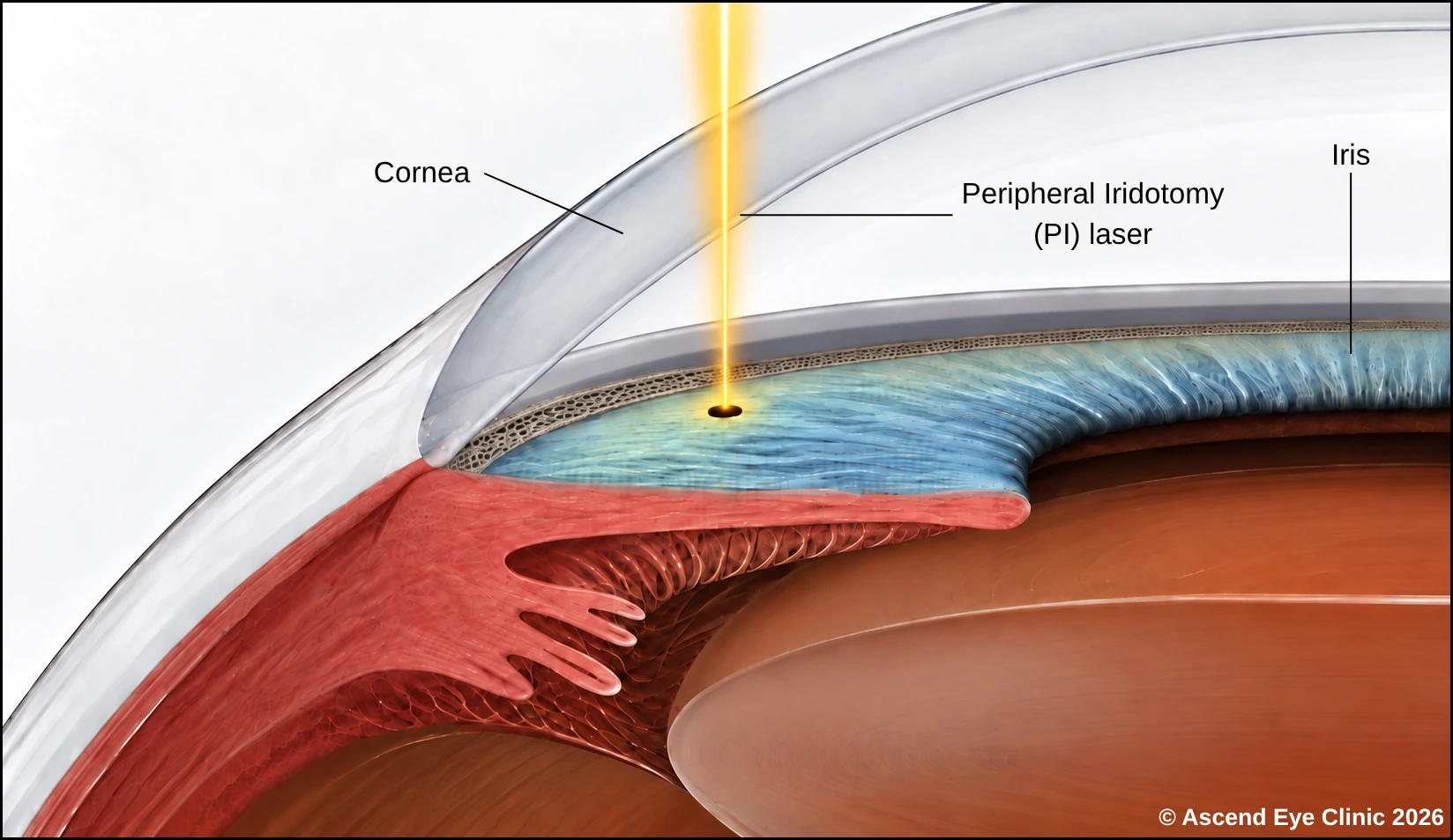 Laser peripheral iridotomy (PI) diagram showing the laser creating an opening in the iris