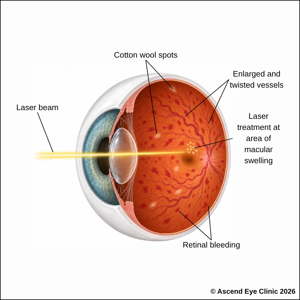 Macular Laser for Central Retinal Vein Occlusion