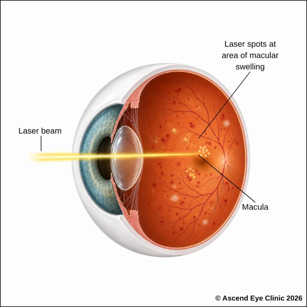 Macular laser treatment for diabetic retinopathy