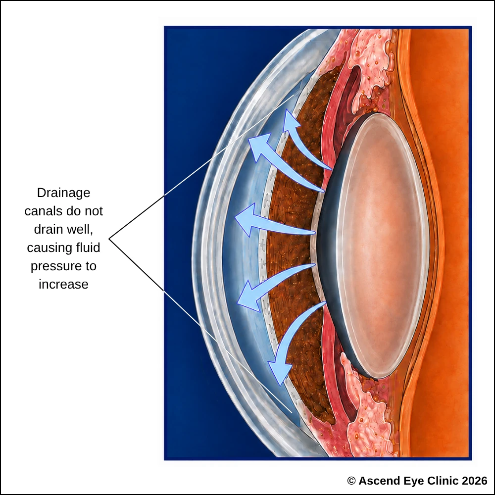 Open angle glaucoma diagram showing drainage canals that do not drain well, causing fluid pressure to increase