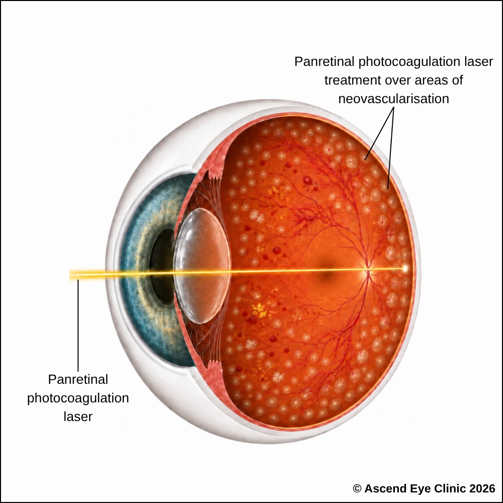 Panretinal Photocoagulation (PRP) for Diabetic Retinopathy