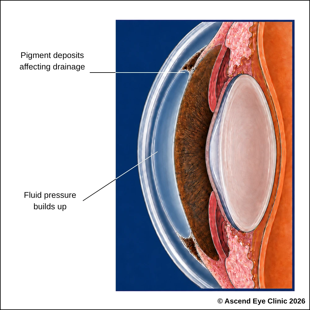 Pigmentary glaucoma diagram showing pigment deposits affecting drainage and fluid pressure building up