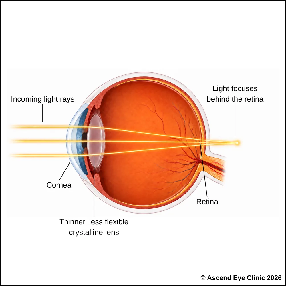 Illustration of presbyopia affecting near focusing