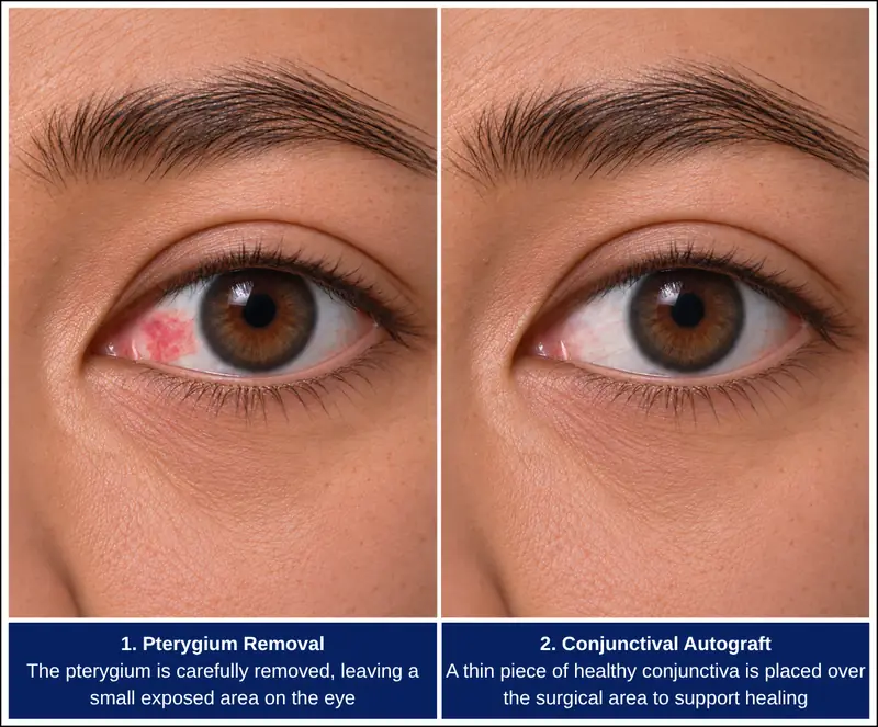Illustration of pterygium removal followed by a conjunctival autograft