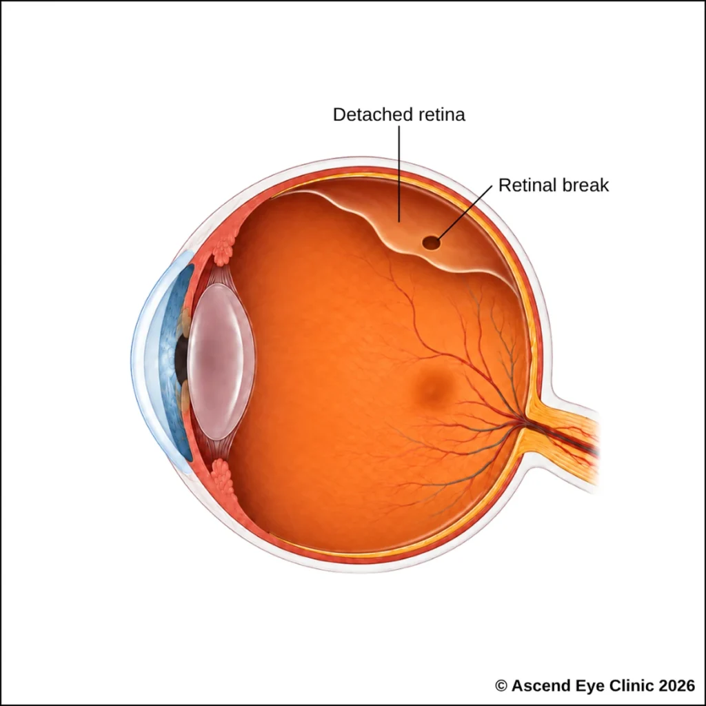 Diagram of a retinal detachment
