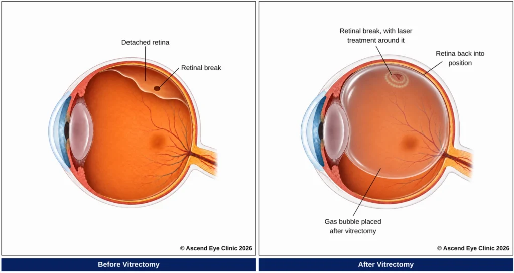 Retinal detachment before and after vitrectomy