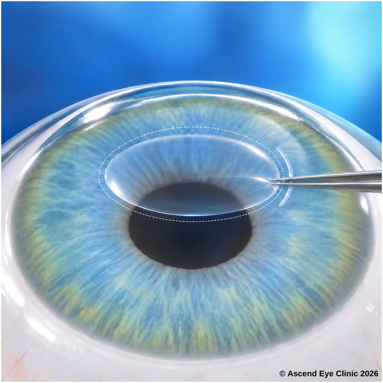 Illustration of SMILE Pro 2.0 showing a lens-shaped piece of corneal tissue removed through a small incision