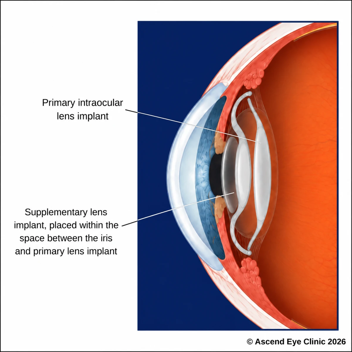 Supplementary lens implant positioned in front of the existing intraocular lens