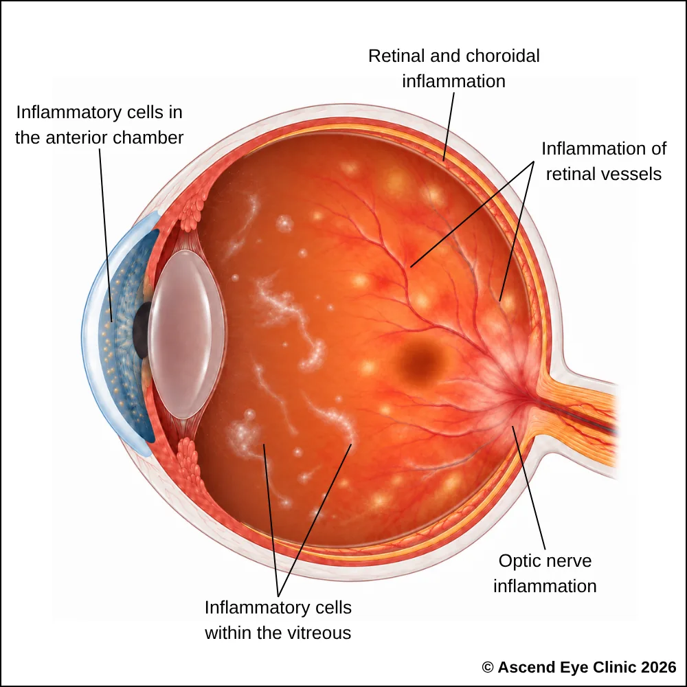 Illustration of uveitis showing inflammation inside the eye