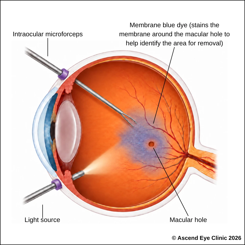 Diagram of vitrectomy surgery to repair a macular hole