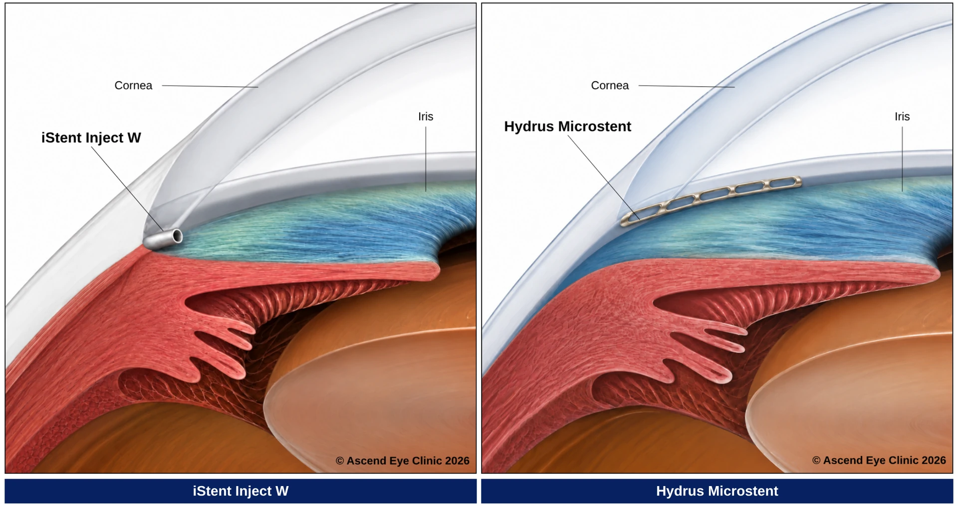 Comparison of the iStent Inject W and Hydrus Microstent MIGS devices placed in the eye